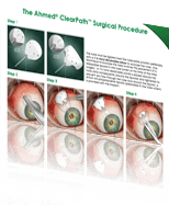 cpt code for thromboendarterectomy with patch graft