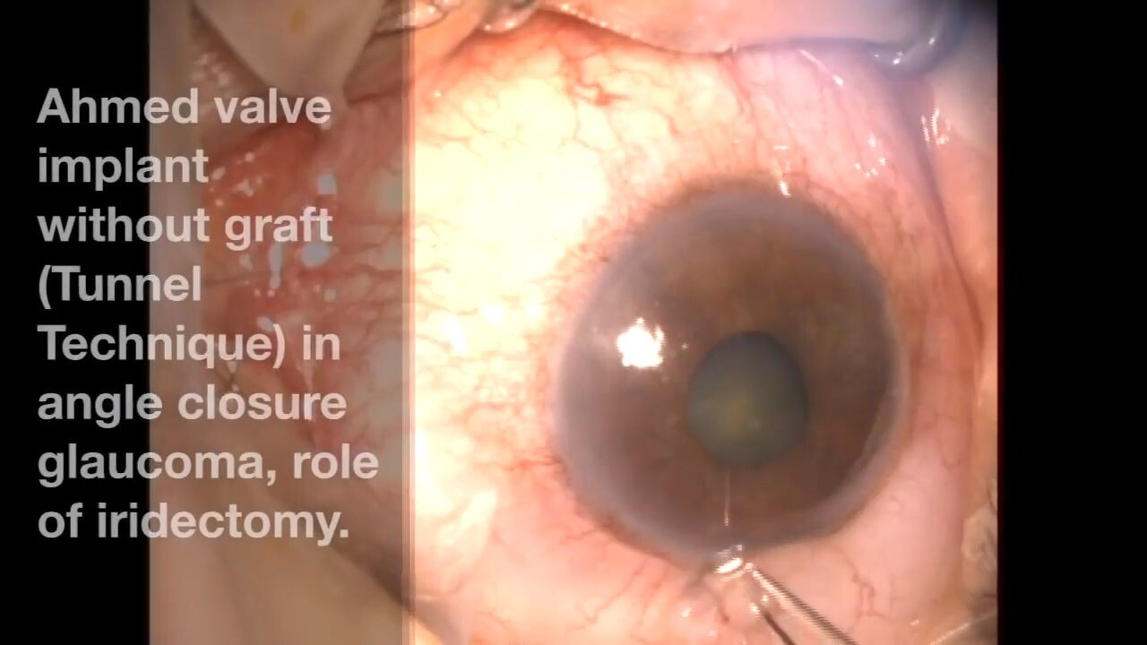 Ahmed valve implant without graft Tunnel Technique - Rafa Castaneda ...